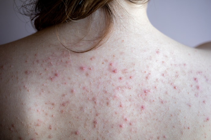More Expert Tips for Dealing With Body Acne