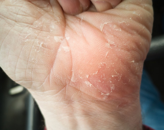 Find Lotions That Can Help Treat Underlying Issues Like Flaking, Psoriasis, and More