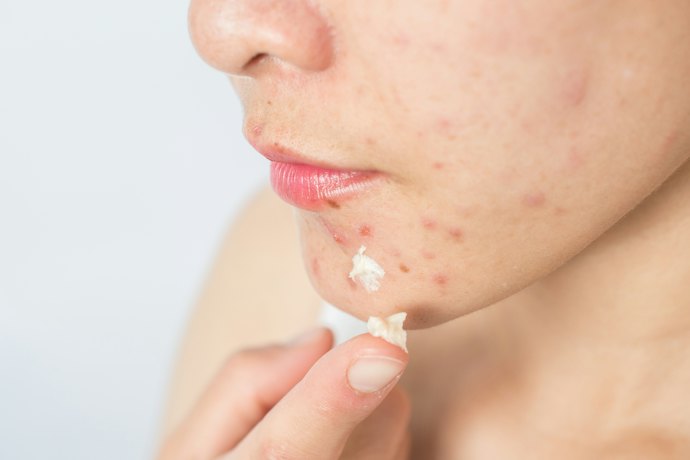 Find Products that Specialize in Dealing with Symptoms of Papulopustular Rosacea (or Acne Rosacea)