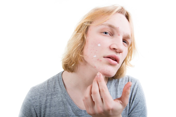 Inflammatory Acne Can Benefit from Benzoyl Peroxide and Tea Tree Oil