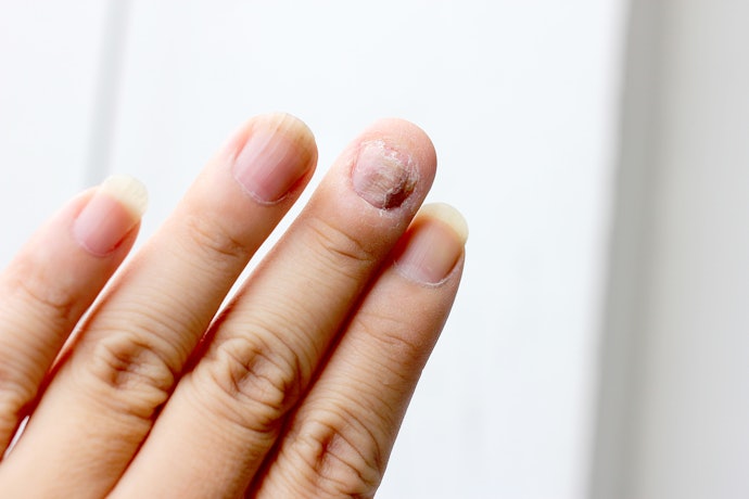 Antifungal Essential Oils to Treat Infections or Nail Psoriasis