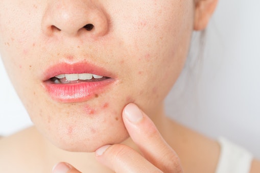 Avoid Comedogenic Ingredients Like Coconut and Algae for Oily and Acne-Prone Skin