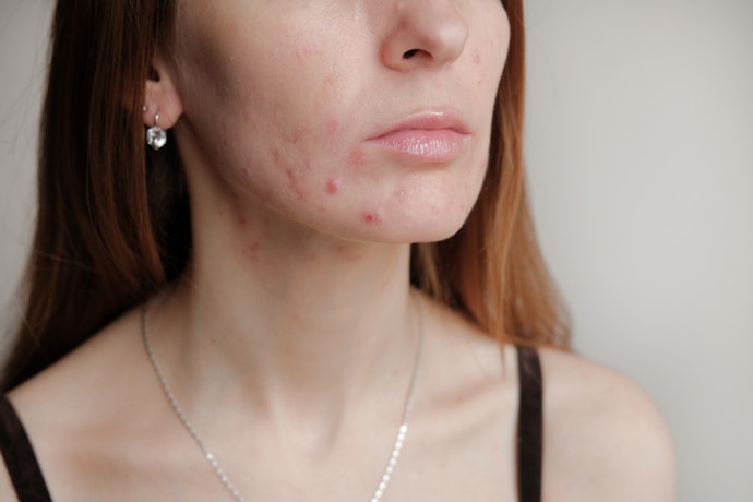 Acne Patches With Microneedles Help Treat Cystic Acne