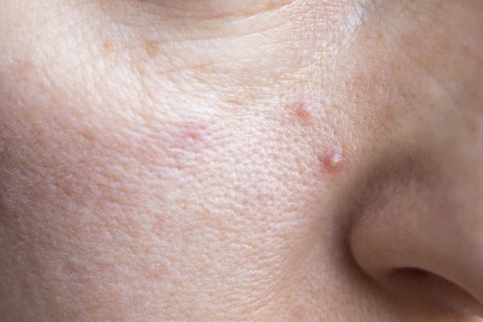 Ingredients Like Salicylic Acid to Treat Acne