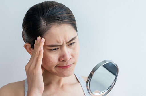 Benzoyl Peroxide, Salicylic Acid, Retinoids, and More for Hormonal Acne
