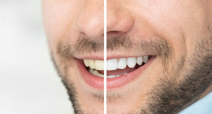 Carbamide Peroxide or Hydrogen Peroxide Helps Whiten Teeth