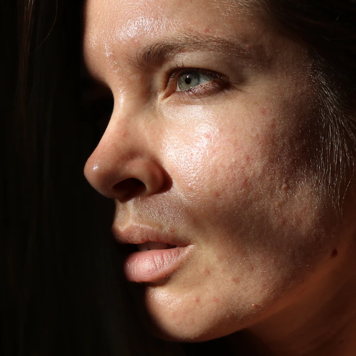 Joanna Kenny's Top 10 SPFs for Acne-Prone Skin