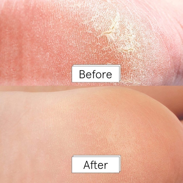 Foot Peel Mask 2