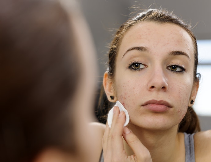 Salicylic Acid and Non-Comedogenic Wipes are Good for Acne-Prone Skin